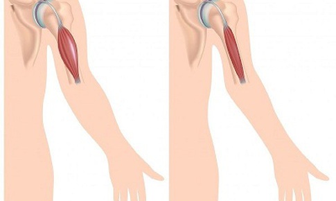 Thuốc mới trị bệnh loạn dưỡng cơ Duchenne do đột biến gen