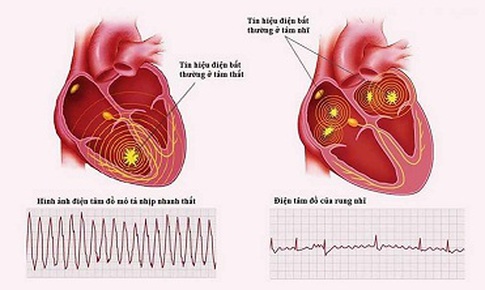 Bỏ h&#250;t thuốc gi&#250;p giảm nguy cơ tử vong do rung t&#226;m nhĩ