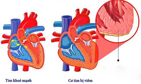 COVID-19 c&#243; thể ảnh hưởng đến tim, ngay cả sau khi đ&#227; hồi phục