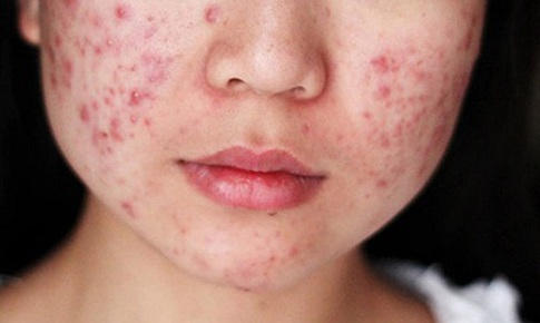 Th&#234;m một thuốc mới trị mụn trứng c&#225;