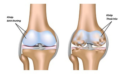 Canakinumab c&#243; thể l&#224;m chậm qu&#225; tr&#236;nh tho&#225;i h&#243;a khớp?