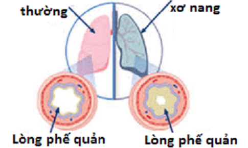 Thuốc cải thiện chức năng phổi ở bệnh nh&#226;n bị xơ nang