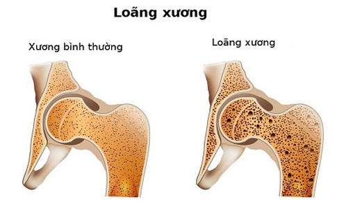 Có thể ngăn ngừa sự phân hủy xương do loãng xương