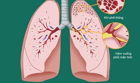 Hướng điều trị mới cho c&#225;c bệnh vi&#234;m đường h&#244; hấp mạn t&#237;nh