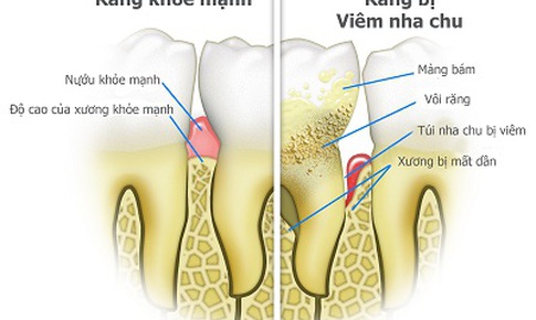 Vi&#234;m nha chu c&#243; li&#234;n quan đến tăng huyết &#225;p