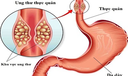 Thuốc tăng cường miễn dịch gi&#250;p k&#233;o cuộc sống ở người ung thư thực quản