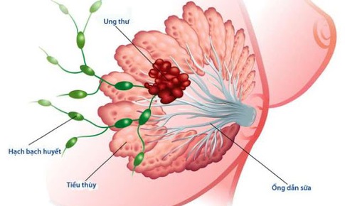 Ung thư có thể gây ảnh hưởng đến tim