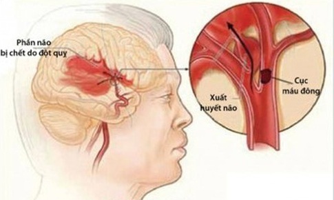 Chấn thương sọ n&#227;o c&#243; thể l&#224;m tăng nguy cơ đột quỵ