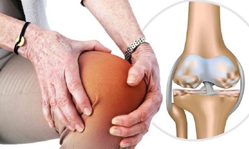 Tho&#225;i h&#243;a khớp li&#234;n quan đến tăng nguy cơ mắc bệnh Parkinson