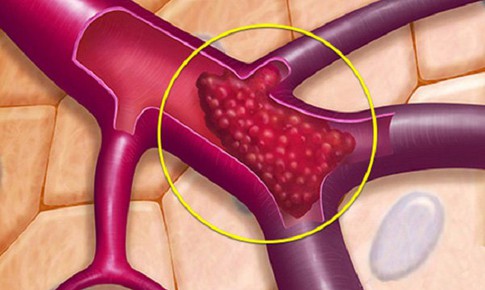 Ph&#234; duyệt thuốc l&#224;m lo&#227;ng m&#225;u đường uống đầu ti&#234;n cho trẻ em