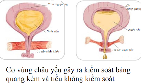 Tiểu kh&#244;ng kiểm so&#225;t c&#243; thể ảnh hưởng đến sức khỏe t&#226;m thần của phụ nữ