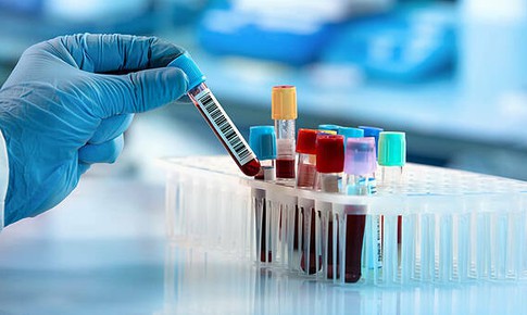 Xét nghiệm máu dự đoán mức độ nặng của COVID-19