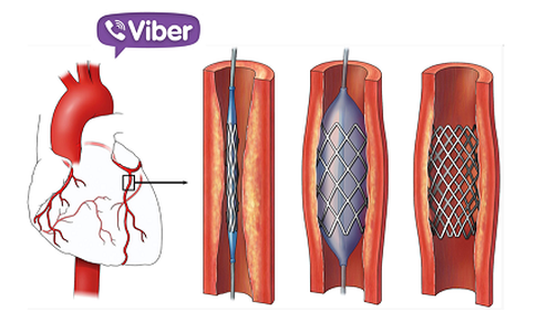 Hội chẩn nhanh qua Viber kịp thời cứu sống bệnh nh&#226;n bị nhồi m&#225;u cơ tim