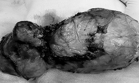 Bướu cổ nặng 1kg được phẫu thuật thành công