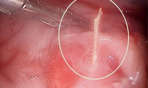 Bé trai 9 tuổi bị que xiên đâm thủng ruột non