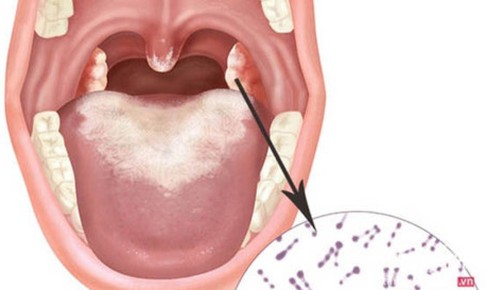 Đắk Lắk: Kh&#244;ng để c&#243; th&#234;m bệnh nh&#226;n tử vong do bệnh bạch hầu