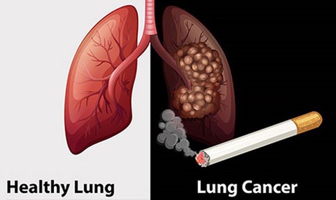 SOS: Th&#234;m 26.000 người Việt mắc ung thư phổi năm 2020, 90% đều h&#250;t thuốc l&#225;