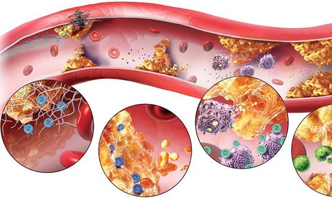 4 bệnh l&#253; chuyển h&#243;a thường gặp ở phụ nữ m&#227;n kinh