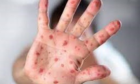 Cảnh gi&#225;c với nguy cơ bệnh sởi &#39;trở lại to&#224;n cầu&#39;