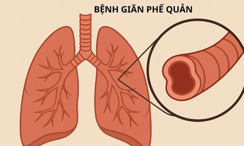 Ho ra m&#225;u&#160;cần cảnh gi&#225;c với&#160;gi&#227;n phế quản