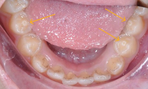 Răng có núm phụ – nguy cơ biến chứng nếu không điều trị kịp thời