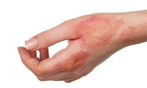 Hội chứng Lyell: Nguyên nhân, biểu hiện, cách điều trị và phòng bệnh