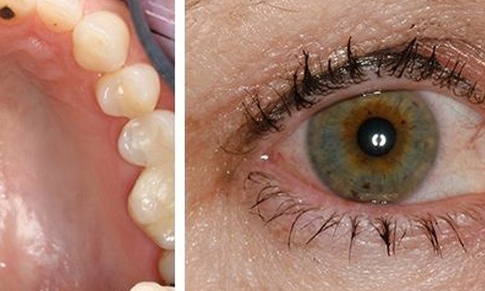 Câu hỏi thường gặp liên quan đến hội chứng Sjogren