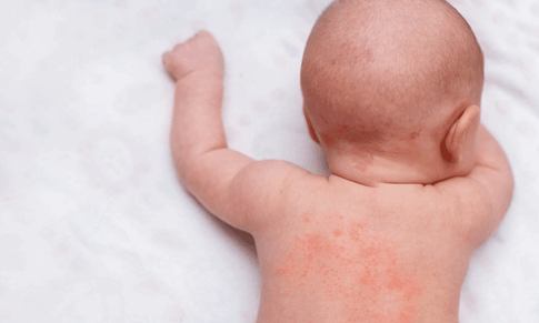 Cách phân biệt phát ban do sởi và phát ban thông thường