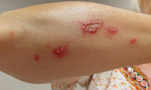 Mùa hè cảnh giác với bệnh da do côn trùng