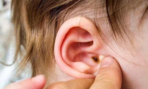 Biến chứng viêm tai giữa ở trẻ nguy hiểm hơn bạn tưởng