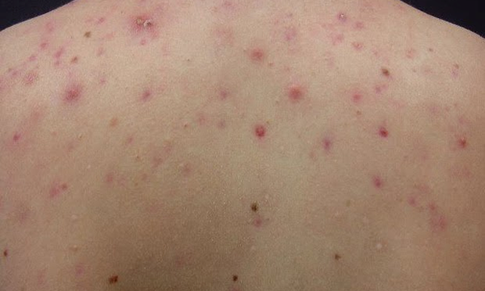 Nóng gan gây nổi mụn lưng?