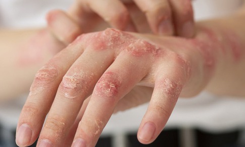 5 bệnh về da nguy hiểm thường gặp sau bão, lũ lụt