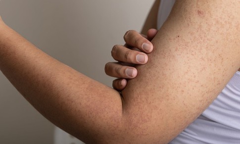 D&#224;y sừng nang l&#244;ng xử tr&#237; thế n&#224;o?