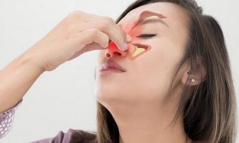 Viêm xoang mũi dị ứng chữa thế nào?