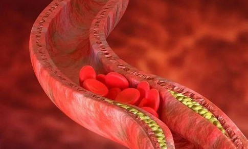 Huyết khối tĩnh mạch s&#226;u nguy hiểm như thế n&#224;o?
