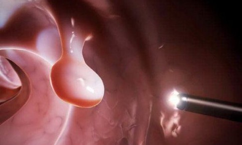 Đa polyp túi mật có nguy hiểm không?