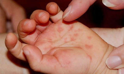 Cách vệ sinh răng miệng và chăm sóc da cho trẻ mắc tay chân miệng tại nhà
