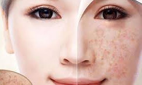 Nhận diện thủ phạm gây đốm đồi mồi trên da
