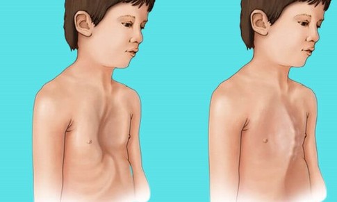 Thanh niên 18 tuổi mắc hội chứng Marfan biến chứng tim mạch nguy hiểm, bác sĩ cảnh báo dấu hiệu nhận biết sớm