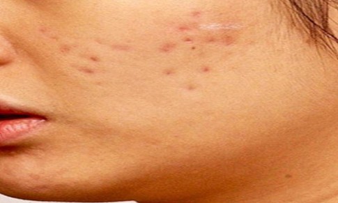 Sẹo rỗ có tự làm đầy được không?