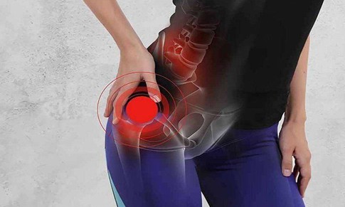 Viêm khớp háng, nhận biết sớm giúp ngăn ngừa hệ lụy