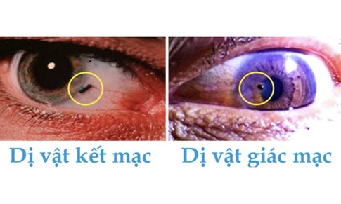 Cảnh báo dị vật mắt khi lao động gây thủng giác mạc