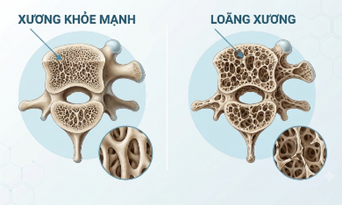 Nguy cơ gây loãng xương: Trường hợp nào cần chủ động đánh giá sức khỏe xương?
