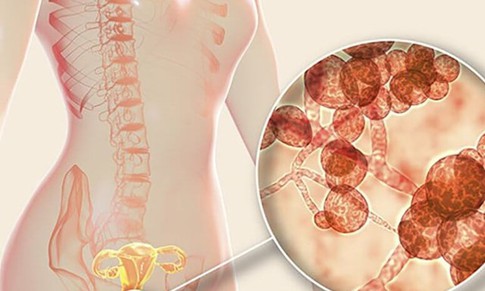 Mẹ bầu mắc nấm âm đạo nên uống thuốc hay đặt thuốc?