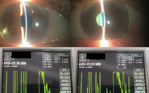 Cụ b&#224; su&#253;t mất thị lực v&#236; gl&#244;c&#244;m, c&#225;ch nhận biết sớm căn bệnh nguy hiểm n&#224;y
