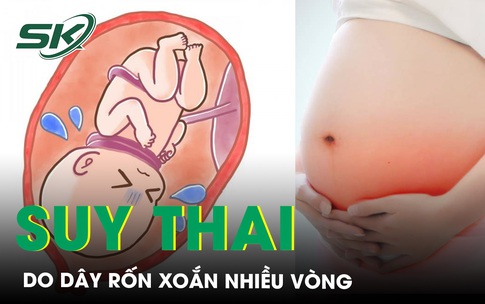 Cứu sống mẹ con sản phụ suy thai, d&#226;y rốn xoắn nhiều v&#242;ng li&#234;n tiếp v&#224; s&#225;t nhau
