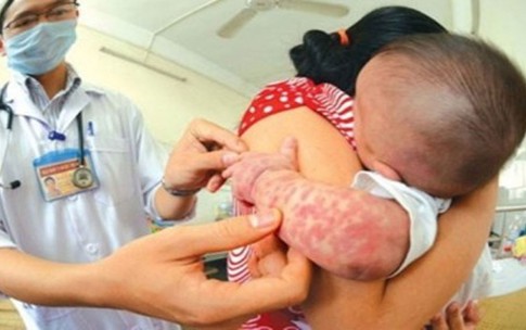 Đ&#227; c&#243; 78 ca sốt ph&#225;t ban nghi sởi, rubella, phải xử l&#253; triệt để ngay khi xuất hiện ca mắc