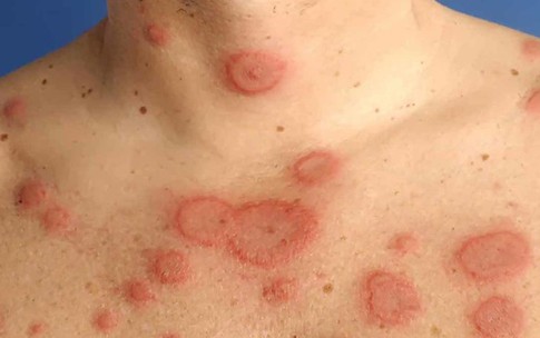 Phát hiện kịp thời trẻ mắc lupus ban đỏ hệ thống