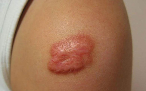 C&#225;c yếu tố nguy cơ g&#226;y sẹo lồi