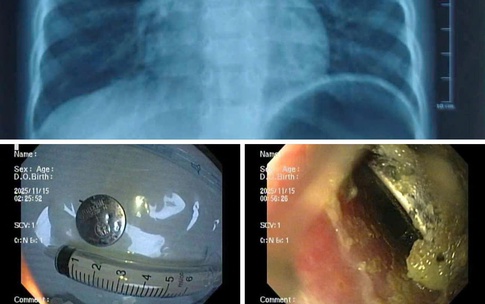 B&#233; trai ở Hải Ph&#242;ng bị lo&#233;t thực quản nặng v&#236; nuốt pin c&#250;c &#225;o
